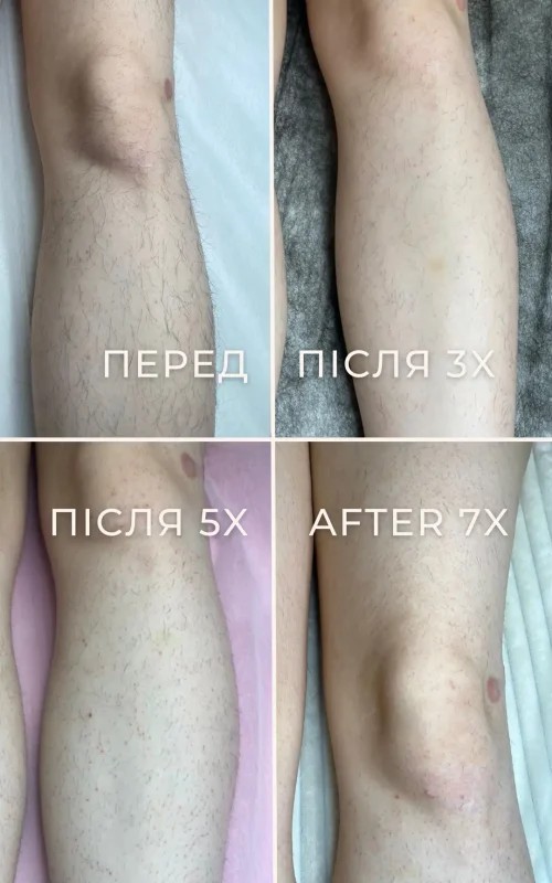 Результат електроепіляції ніг до та після