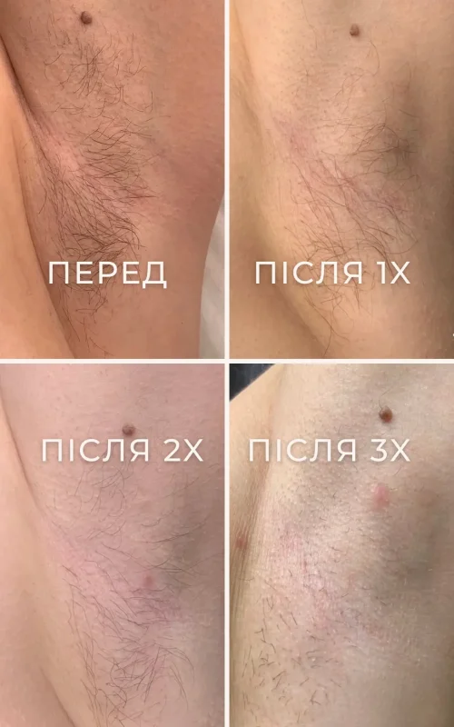 Результат електроепіляції до та після 1, 2 і 4 процедур