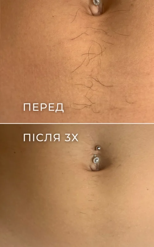 Результат електроепіляції живота до та після 3 процедур.