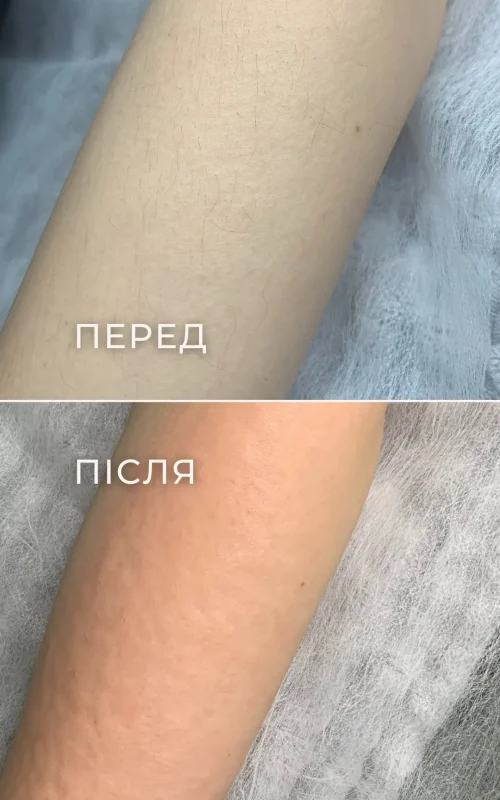 Результат електроепіляції передпліччя до та після Заголовок
