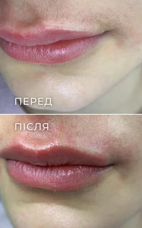 Результат електроепіляції верхньої губи до та після